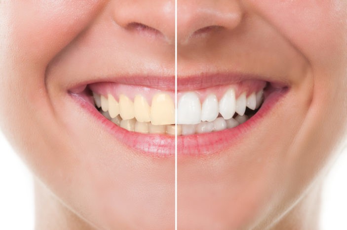 بہاؤ کے ساتھ دانتوں کو تیز کرنے کے ضمنی اثرات