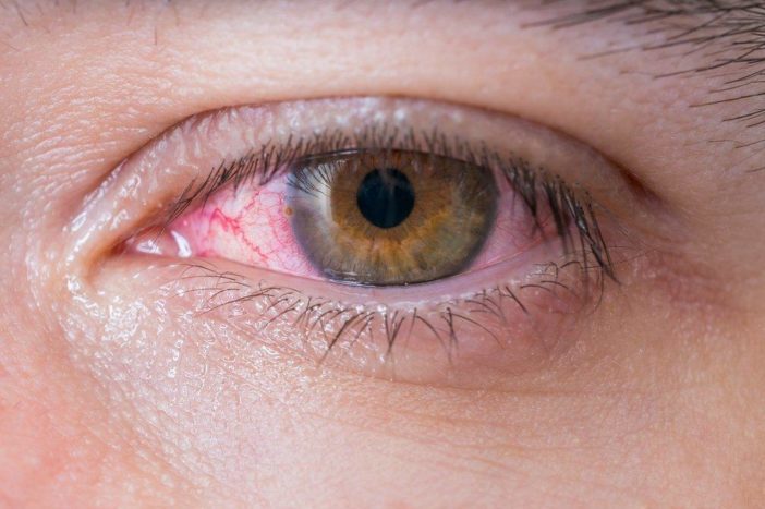 الرجک سرخ آنکھ کوانٹیکٹوائٹس
