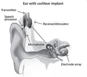 Cochlear امپلانٹ آلہ