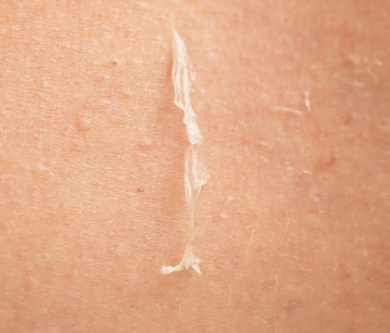 چھلیوں کی جلد پر قابو پانے کا سبب بنتا ہے
