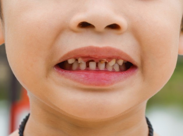 بچوں کے دانتوں کو نقصان پہنچانا