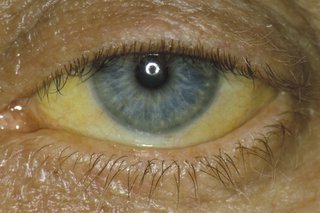 پیلے رنگ کی آنکھیں